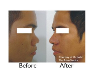 Noselift (Augmentation Rhinoplasty with Alarplasty) in Asian male subject, before and after photos 