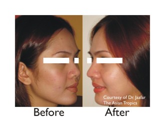 Nose lift or nose augmentation